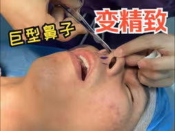 小哥哥想Do鼻变帅增加桃花！