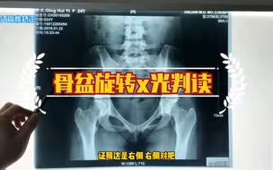 骨盆旋转髂骨内外翻在x光的呈现