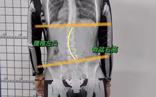 腰椎侧弯？骨盆倾斜？一个动作同时矫正