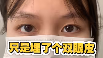 6mm埋线双眼皮恢复半年后