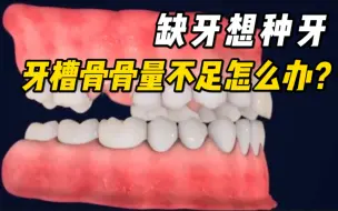缺牙想做种植牙，可是牙槽骨骨量不足做不了？可以试试这个方法