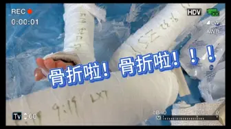 【VLOG】今日限定“骨折”打石膏专场！