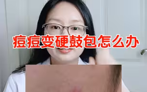 痘痘变成硬硬的鼓包，硬块痘痘怎么快速消除